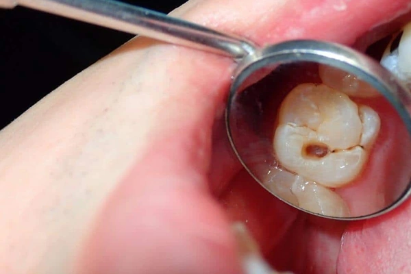 Protección de la estructura dental