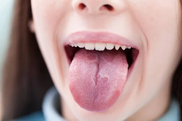 10 causas de la lengua blanca que debes saber