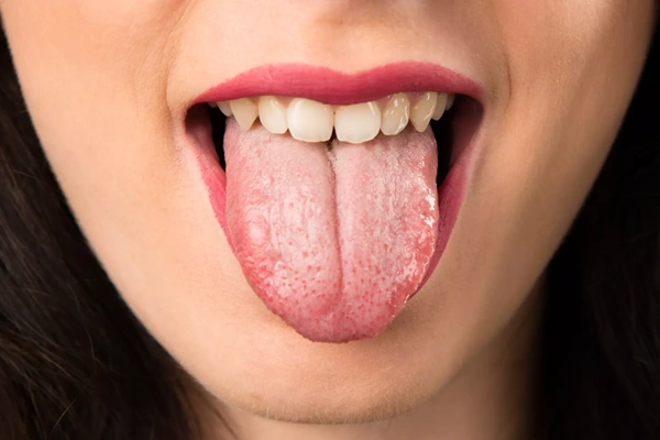 10 causas de la lengua blanca que debes saber