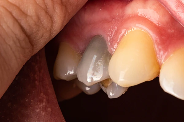 10 causas de los dientes negros que debes conocer