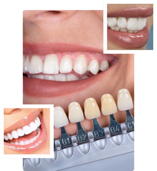 Carillas dentales en Magdalena
