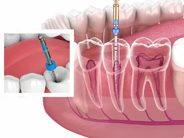 Cómo es el procedimiento de endodoncia unirradicular