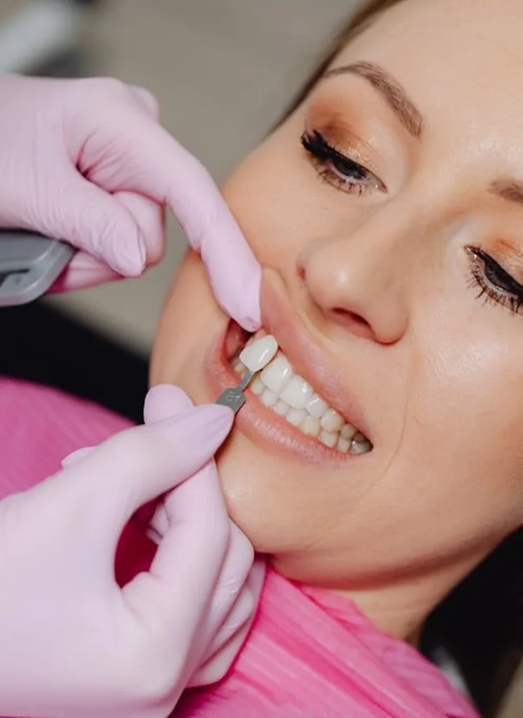 Cómo es el proceso para colocarse carillas dentales