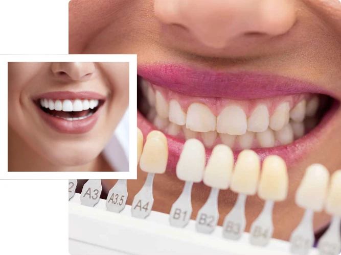 Consultorio en carillas dentales en Magdalena cerca de ti