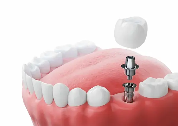 Coronas sobre implantes en Magdalena