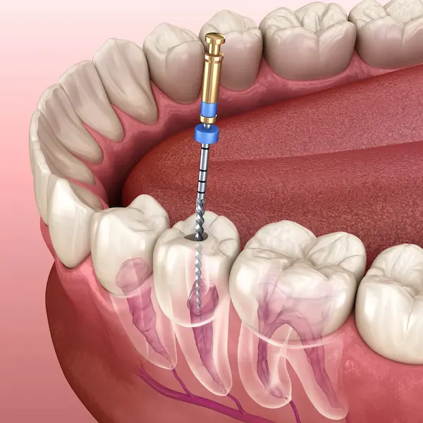 Cuánto cuesta una endodoncia unirradicular en Lima