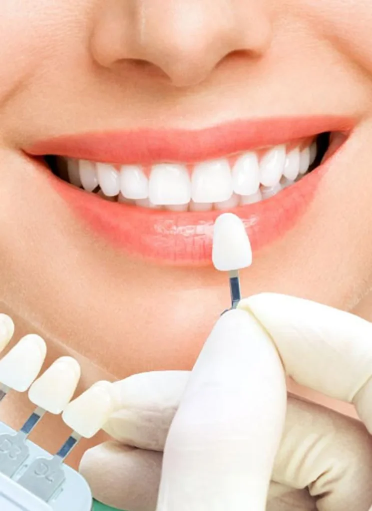 Cuánto duran las carillas dentales