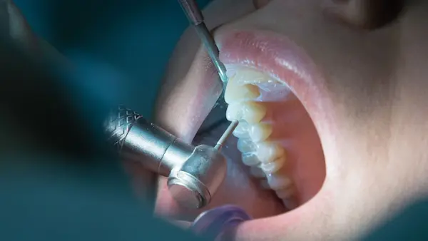 Dientes con endodoncia
