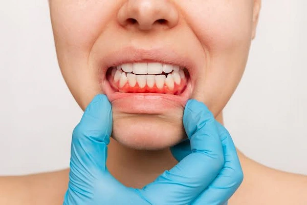 Encías inflamadas o sangrado frecuente