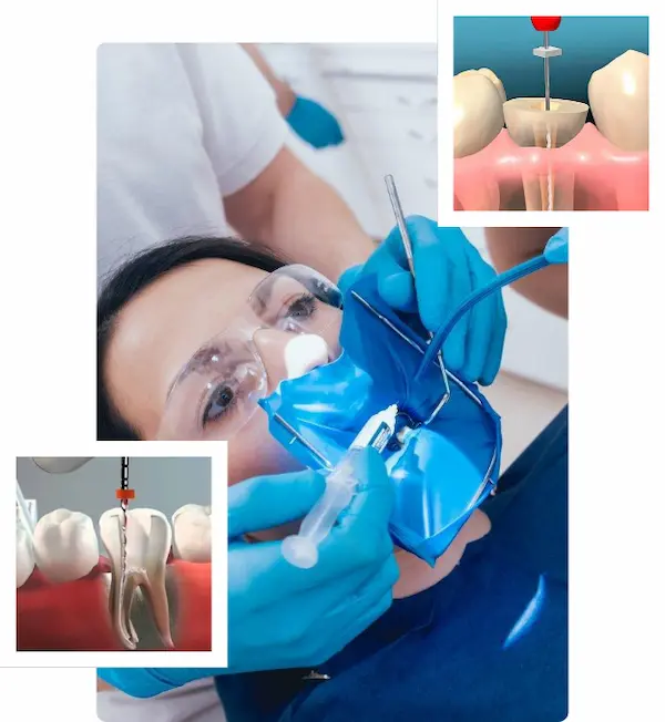 Endodoncia unirradicular en Lima Perú