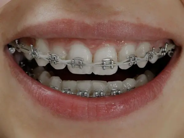 Ideas de combinaciones de mejores colores ligas de brackets para mujer