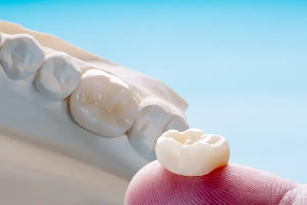 Qué es una corona dental
