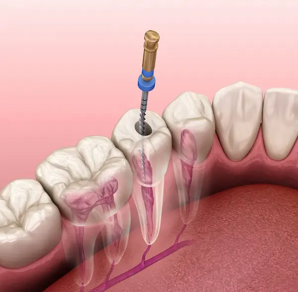 Tratamiento de conducto en dientes de una raíz en Lima