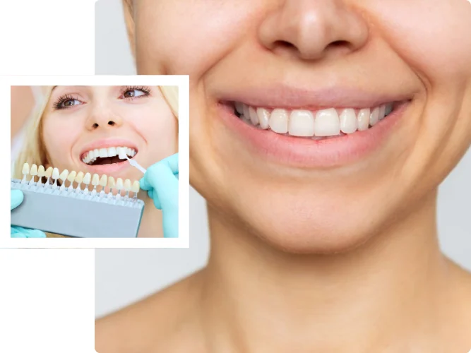 Veneers dentales en San Isidro_