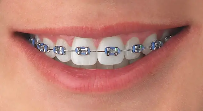 Colores de ligas para brackets que hacen ver los dientes más blancos