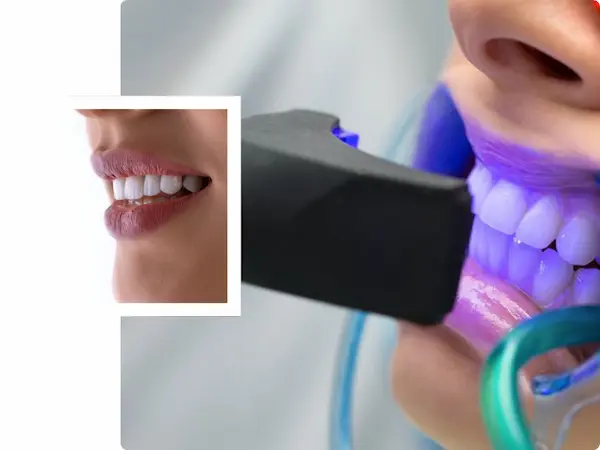 Blanqueamiento dental profesional en Magdalena con evaluación previa