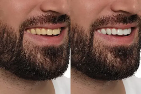 Candidatos ideales para blanqueamiento dental y evaluación previa necesaria