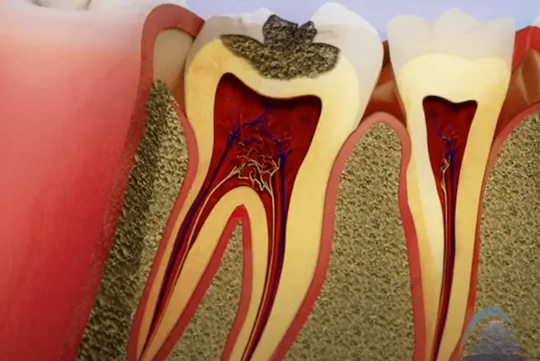 Caries de dentina