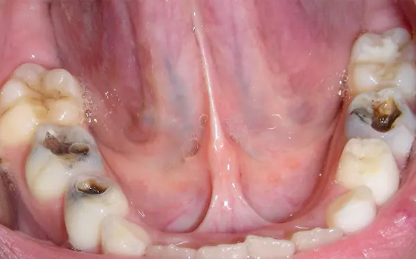 Caries oclusales o de fisura (en muelas)