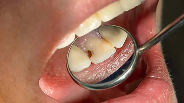 Cómo saber qué tipo de caries tienes realmente