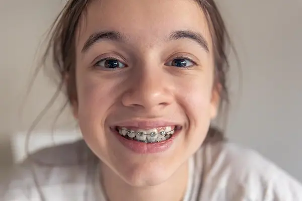 Dientes desalineados