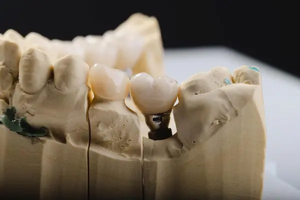 Duele un injerto óseo dental y cómo es la recuperación