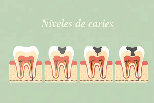 Niveles de caries