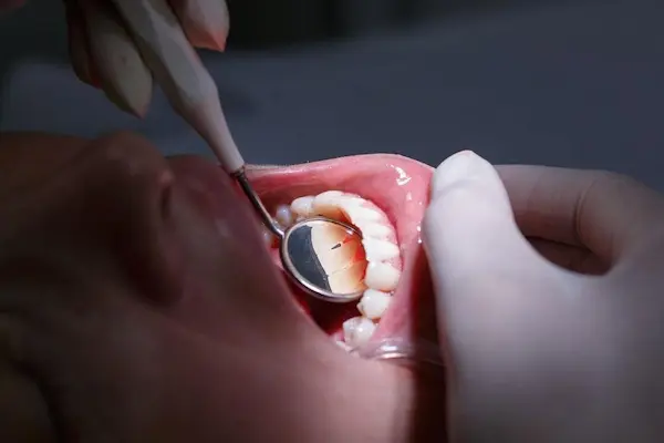 Pérdida irreversible del soporte óseo y movilidad dental