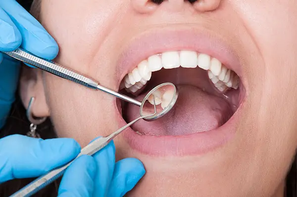Principales factores que aceleran el avance de las caries