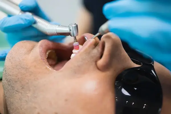 Qué es la profilaxis dental y por qué es importante