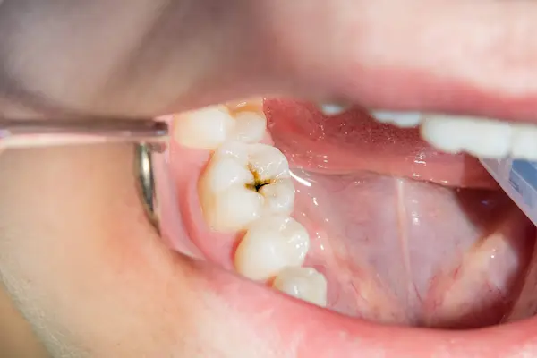 Qué son las caries y por qué aparecen