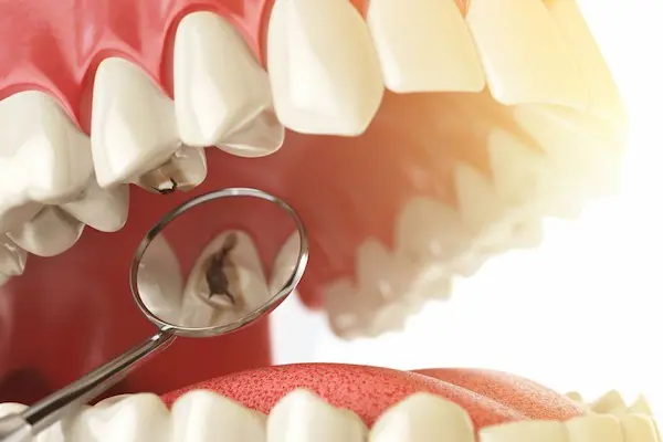 Qué tipo de caries avanza más rápido