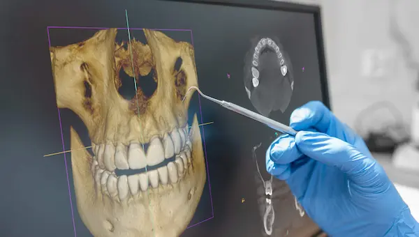 Regeneración ósea dental y recuperación del hueso