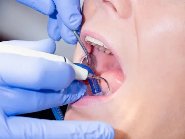 Señales de que necesitas una limpieza dental