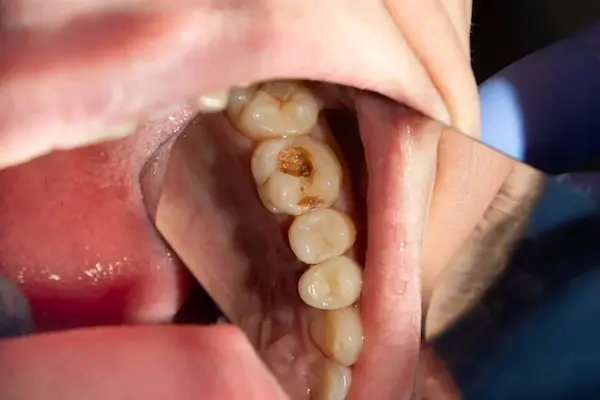 Tipos de caries y cómo identificarlas correctamente