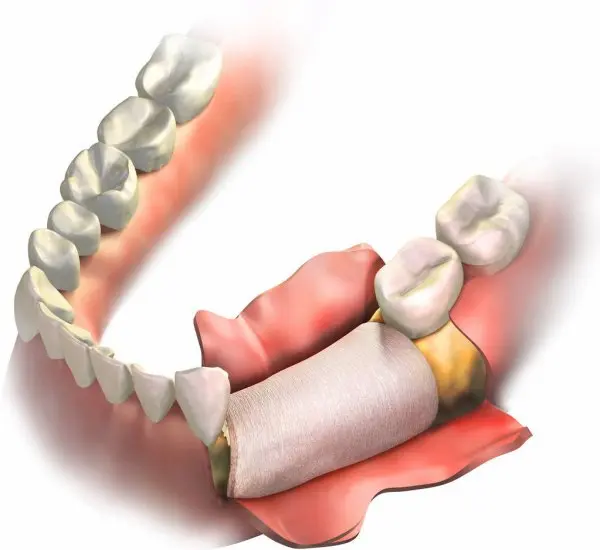 Tipos de injerto óseo dental según cada caso