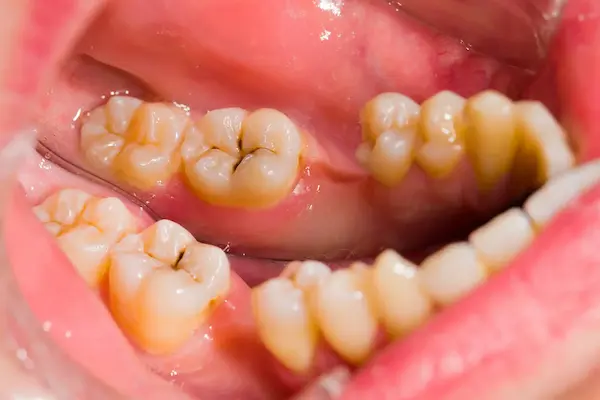 Tipos de manchas en los dientes que pueden indicar caries