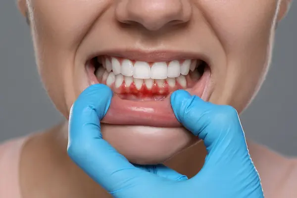 Tratamiento para gingivitis