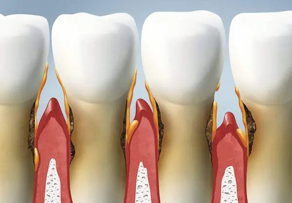 Tratamiento para periodontitis moderada