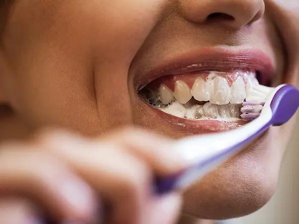 Cómo prevenir manchas blancas en los dientes