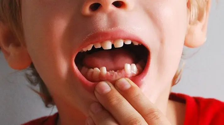 Dientes de leche dañados o con dolor