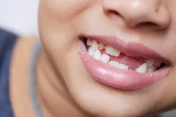 Hay que cuidar los dientes de leche si igual se van a caer