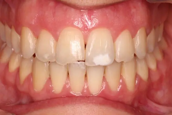 Hipoplasia del esmalte