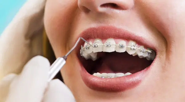 Manchas blancas después de usar brackets