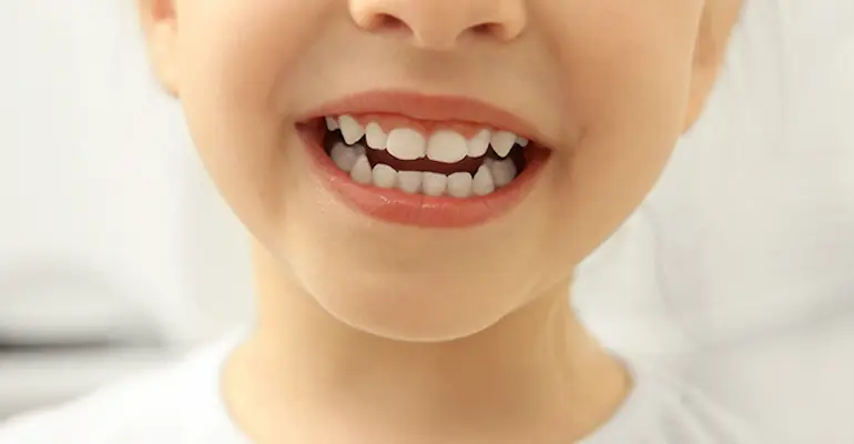 Manchas en dientes de niños