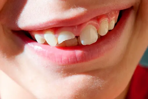 Mordida o dientes desalineados en niños