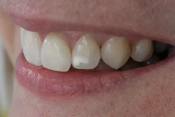 Por qué tengo manchas blancas en los dientes