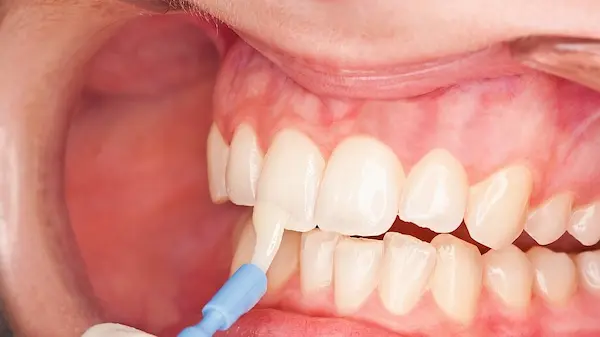 Preguntas frecuentes sobre manchas blancas en los dientes