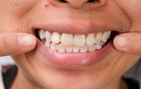 Qué son las manchas blancas en los dientes