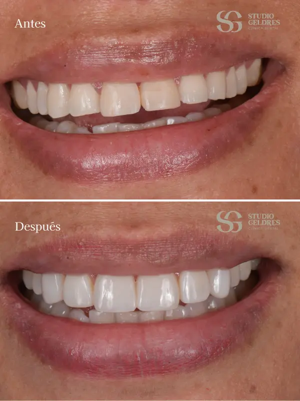 Resultados reales de mejora dental con nuestros dentistas en Lima
